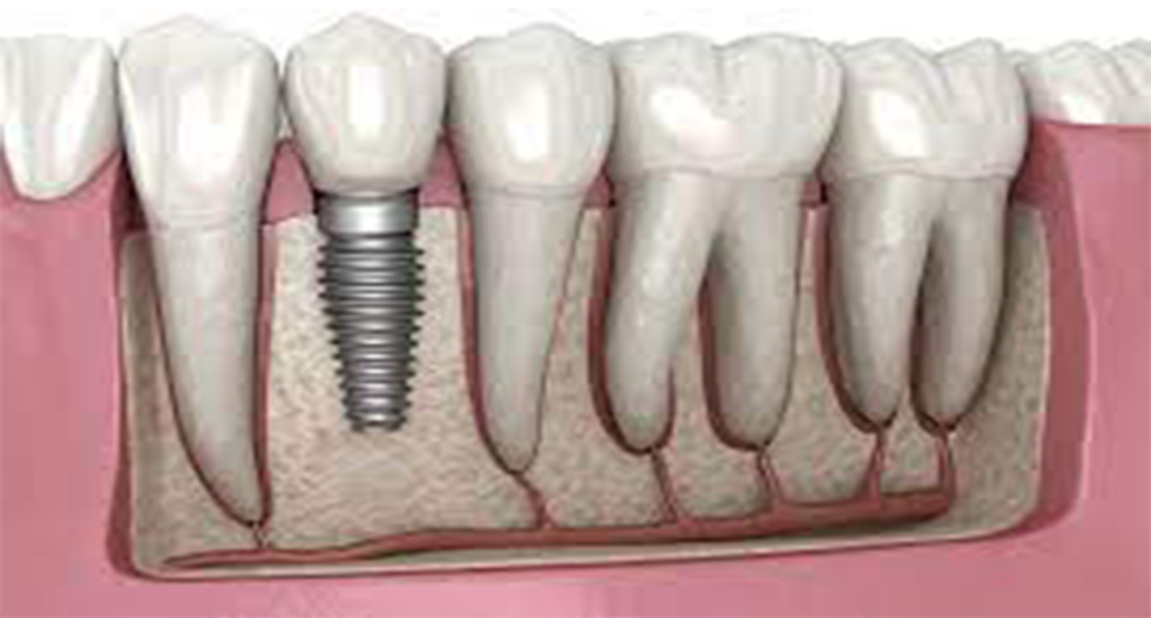 Implantes dentales