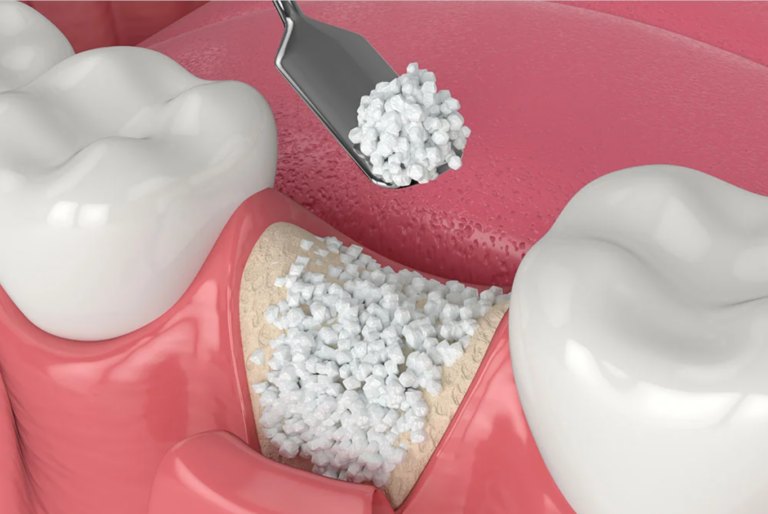 Bone Grafting