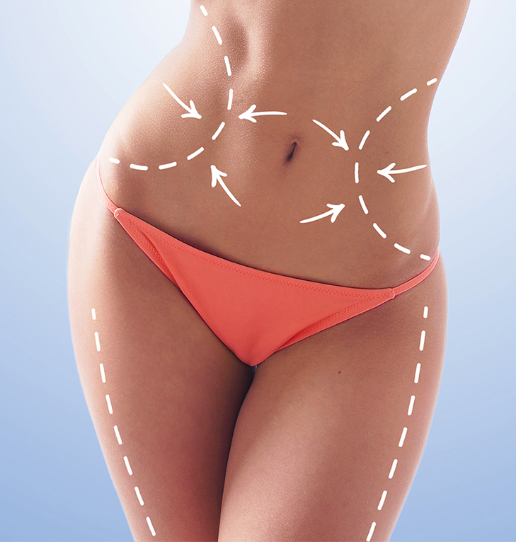 Liposuction