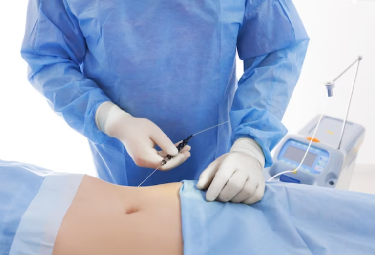 Vaser Liposuction Single Field