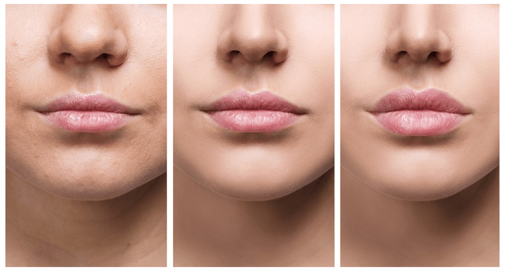 Lip Lifting